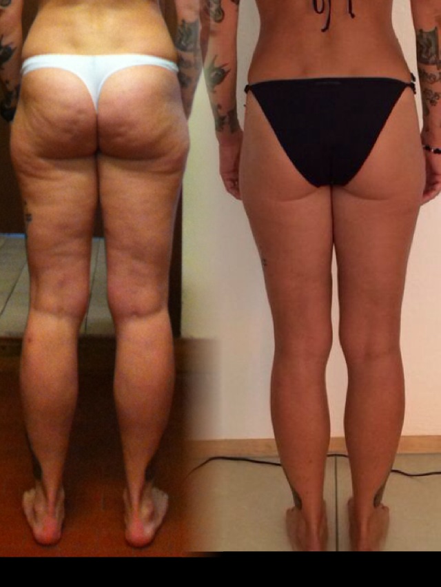 eliminare cellulite cosce